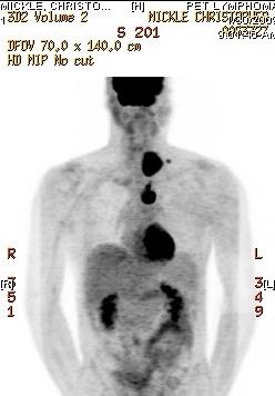 PET scan 0/30/09